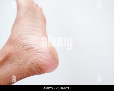 Dry and cracked soles of feet on a white background. cracked skins Stock Photo