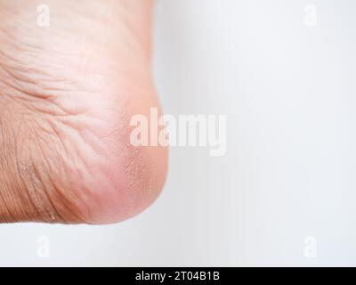 Dry and cracked soles of feet on a white background. cracked skins Stock Photo