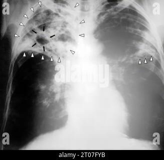 An anteroposterior X-ray of a patient diagnosed with advanced bilateral pulmonary tuberculosis. This AP X-ray of the chest reveals the presence of bilateral pulmonary infiltrate (white triangles), and caving formation (black arrows) present in the right apical region.The diagnosis is far-advanced tuberculosis Stock Photo