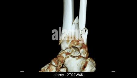 CT Scan ankle joint 3D Rendering image showing fracture tibia and ...