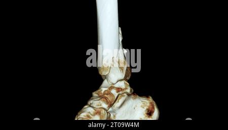 CT Scan ankle joint 3D Rendering image showing fracture tibia and ...