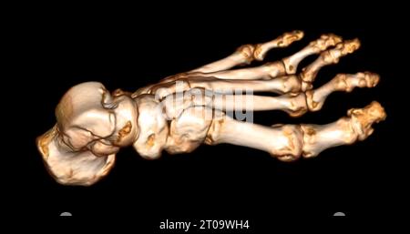 Foot 3D Scan for diagnosis foot diseases by CT-SCANNER . Stock Photo