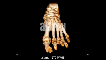 Foot 3D Scan for diagnosis foot diseases by CT-SCANNER . Stock Photo