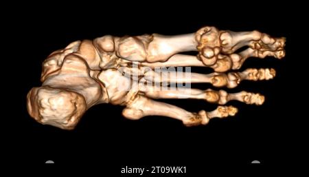 Foot 3D Scan for diagnosis foot diseases by CT-SCANNER . Stock Photo