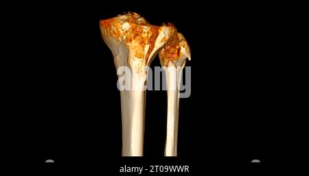 CT Scan of Knee joint showing fracture tibia and fibula bone 3D ...