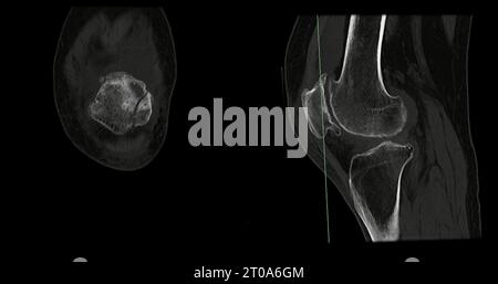 CT Scan of Knee joint sagittal and coronal in case fracture patella ...