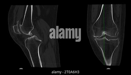 CT Scan of Knee joint sagittal and coronal in case fracture patella ...