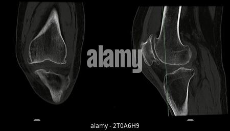 CT Scan of Knee joint sagittal and coronal in case fracture patella ...