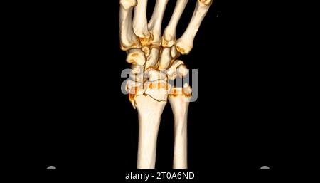 CT scan of wrist joint 3D rendering for diagnosis wrist joint pain. Stock Photo