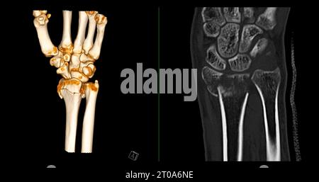 CT scan of wrist joint 3D rendering for diagnosis wrist joint pain. Stock Photo