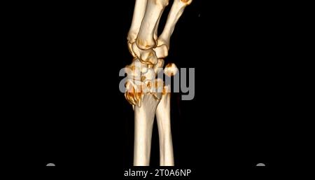 CT scan of wrist joint 3D rendering for diagnosis wrist joint pain. Stock Photo