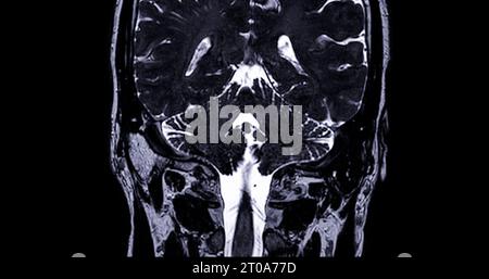 MRI  scan  of  the internal auditory canal (IAC) . Stock Photo