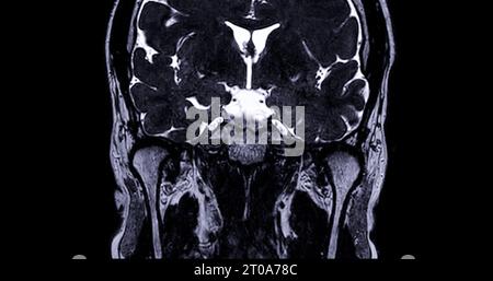 MRI  scan  of  the internal auditory canal (IAC) . Stock Photo