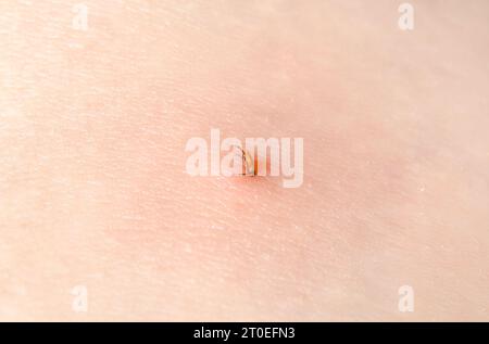 Tick on skin of woman after walk forest, close up. Castor bean tick attached to skin starting to draw blood. Known as Deer or Sheep tick or Ixodes ric Stock Photo
