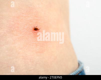 Tick on waist of woman after walk forest. Castor bean tick attached to skin and started to draw blood. Known as Deer or Sheep tick or Ixodes ricinus. Stock Photo