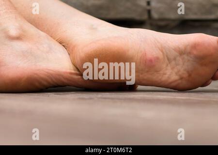 Pink skin on a wart on the sole of a foot on a wood floor. Stock Photo