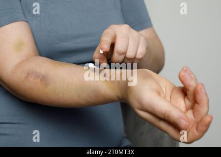 Woman rubs her hand with an ointment of pain. Hand cream against bruise Stock Photo