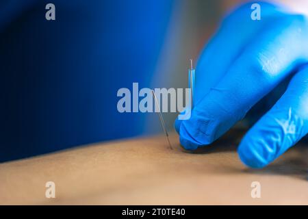 Close up of a needle and hands of physiotherapist doing a dry needling. Stock Photo