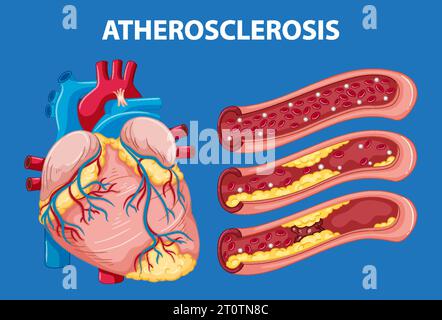Cartoon illustration explaining heart anatomy and atherosclerosis ...