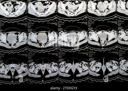 Cairo, Egypt, October 3 2023: Multi slice CT scan abdomen and pelvis shows right ovarian cyst 3 x 3cm, colonic gaseous distension, no sizable urinary Stock Photo