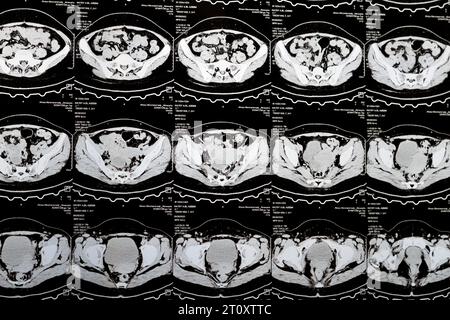 Cairo, Egypt, October 3 2023: Multi slice CT scan abdomen and pelvis shows right ovarian cyst 3 x 3cm, colonic gaseous distension, no sizable urinary Stock Photo