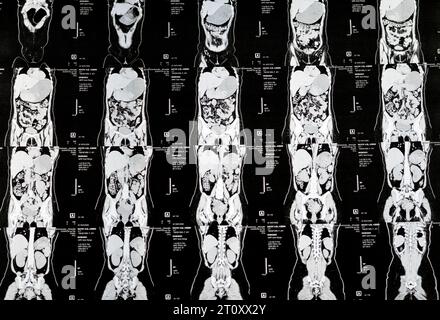 Cairo, Egypt, October 3 2023: Multi slice CT scan abdomen and pelvis shows right ovarian cyst 3 x 3cm, colonic gaseous distension, no sizable urinary Stock Photo
