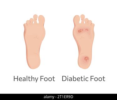 Diabetic and healthy feet vector illustration. Stock Vector