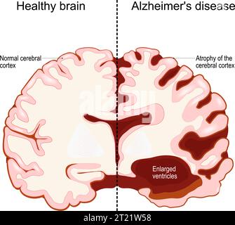human brain, in two halves: healthy and Alzheimer's disease. Neurodegenerative disorder. Dementia. Memory loss and Cognitive decline. Cross section of Stock Vector