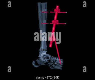 CT Scan ankle joint 3D Rendering image showing fracture tibia and ...