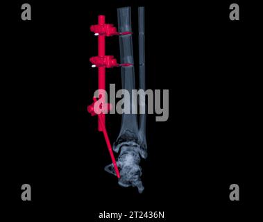 CT Scan ankle joint 3D Rendering image showing fracture tibia and ...