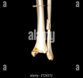 CT Scan ankle joint 3D Rendering image showing fracture tibia and ...