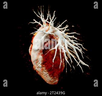 CTA Chest  or CTPA with contrast media 3D rendering  for diagnostic Pulmonary embolism (PE) . Stock Photo
