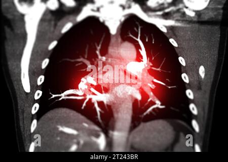 CTA Chest  or CTPA with contrast media coronal view showing Pulmonary embolism (PE) . Stock Photo