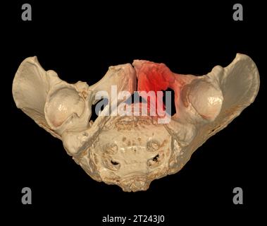 CT Scan of pelvic bone 3D rendering image showing superior pubic ramus ...