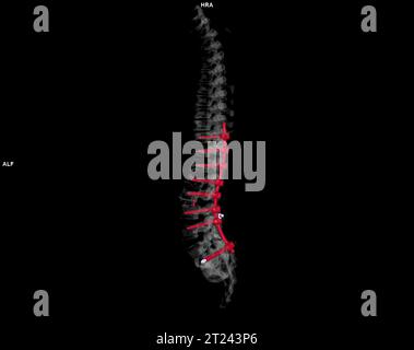 CT scan of thoracic and lumbar spine 3d rendering Stock Photo - Alamy