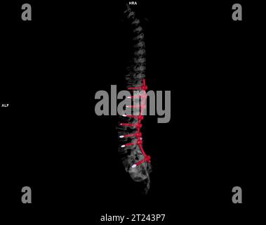 CT scan of thoracic and lumbar spine 3d rendering Stock Photo - Alamy