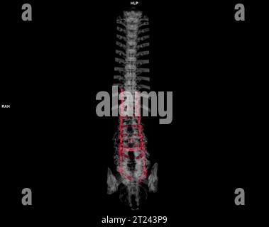 CT scan of thoracic and lumbar spine 3d rendering Stock Photo - Alamy