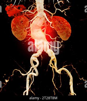 CTA abdominal aorta showing abdomenal aortic dissection 3D rendering. Stock Photo