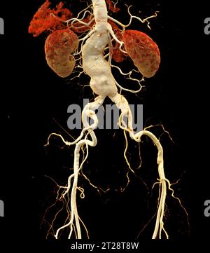 CTA abdominal aorta showing abdomenal aortic dissection 3D rendering. Stock Photo