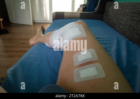 A person is resting after varicose vein surgery. Close-up of a man's leg with adhesive bandages after surgery for varicose veins using laser technolog Stock Photo