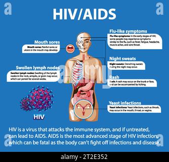 Illustrated infographic depicting the impact of HIV/AIDS on the body's immune system Stock Vector