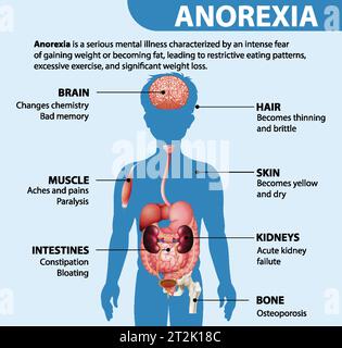Illustration depicting the impact of Anorexia on various body functions ...