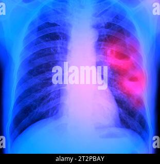 Lung abscesses, X-ray Stock Photo