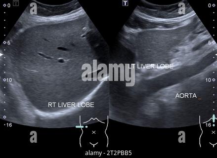 Healthy liver, ultrasound scan Stock Photo