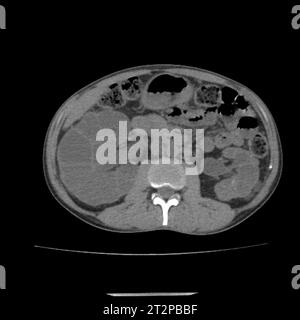 Polycystic kidney disease, CT scan Stock Photo - Alamy