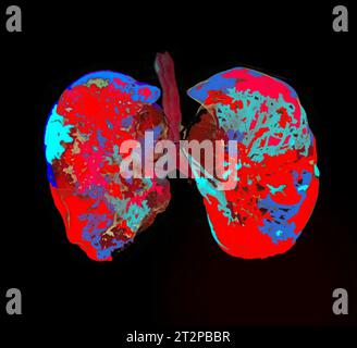 Healthy lungs, CT scan Stock Photo