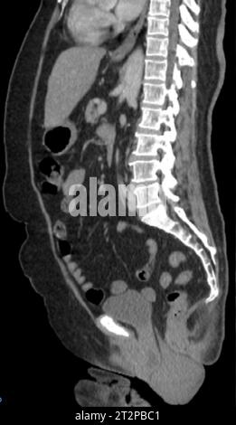 Prolapsed uterus, CT scan Stock Photo