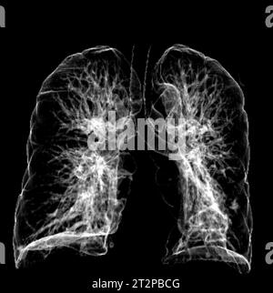 Healthy lungs, CT scan Stock Photo