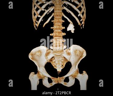 Kidney stone, 3D CT scan Stock Photo