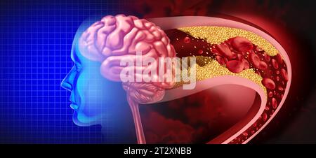 Brain Stroke Attack as a Cerebral arteriosclerosis disease as a blocked artery due to plaque buildup with 3D illustration elements. Stock Photo